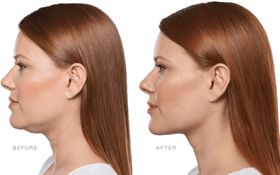Using Allergan Aesthetics KYBELLA® to Address Your Double Chin